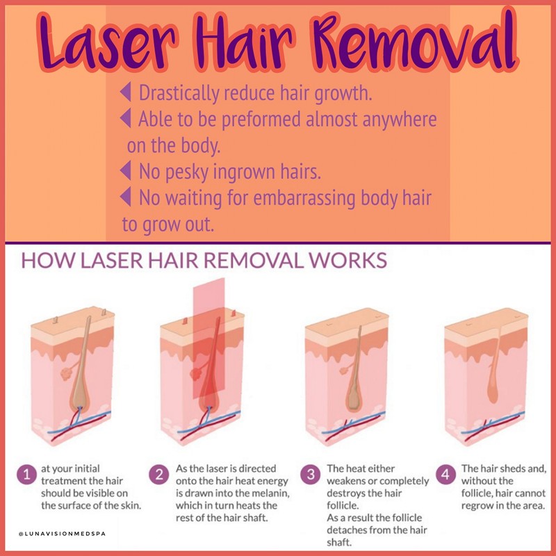 best hair laser removal